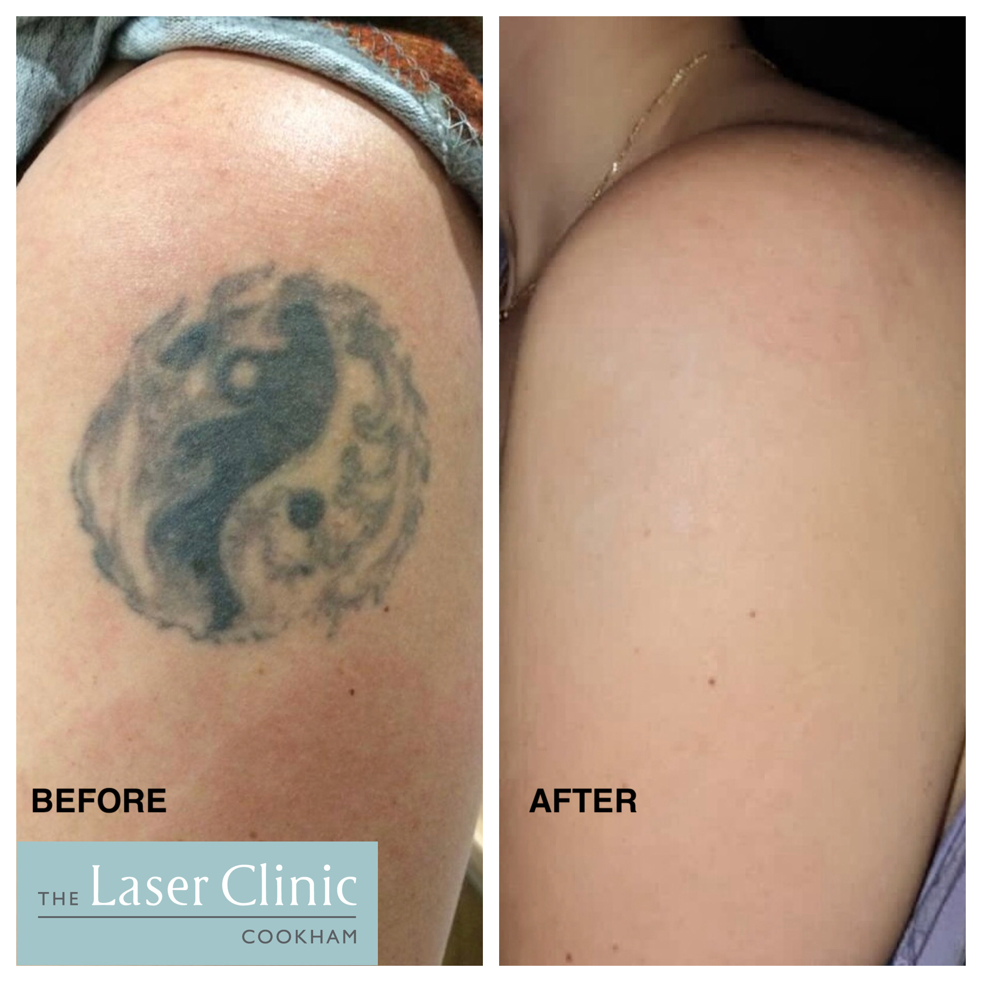 Tattoo Removal Treatment | Laser