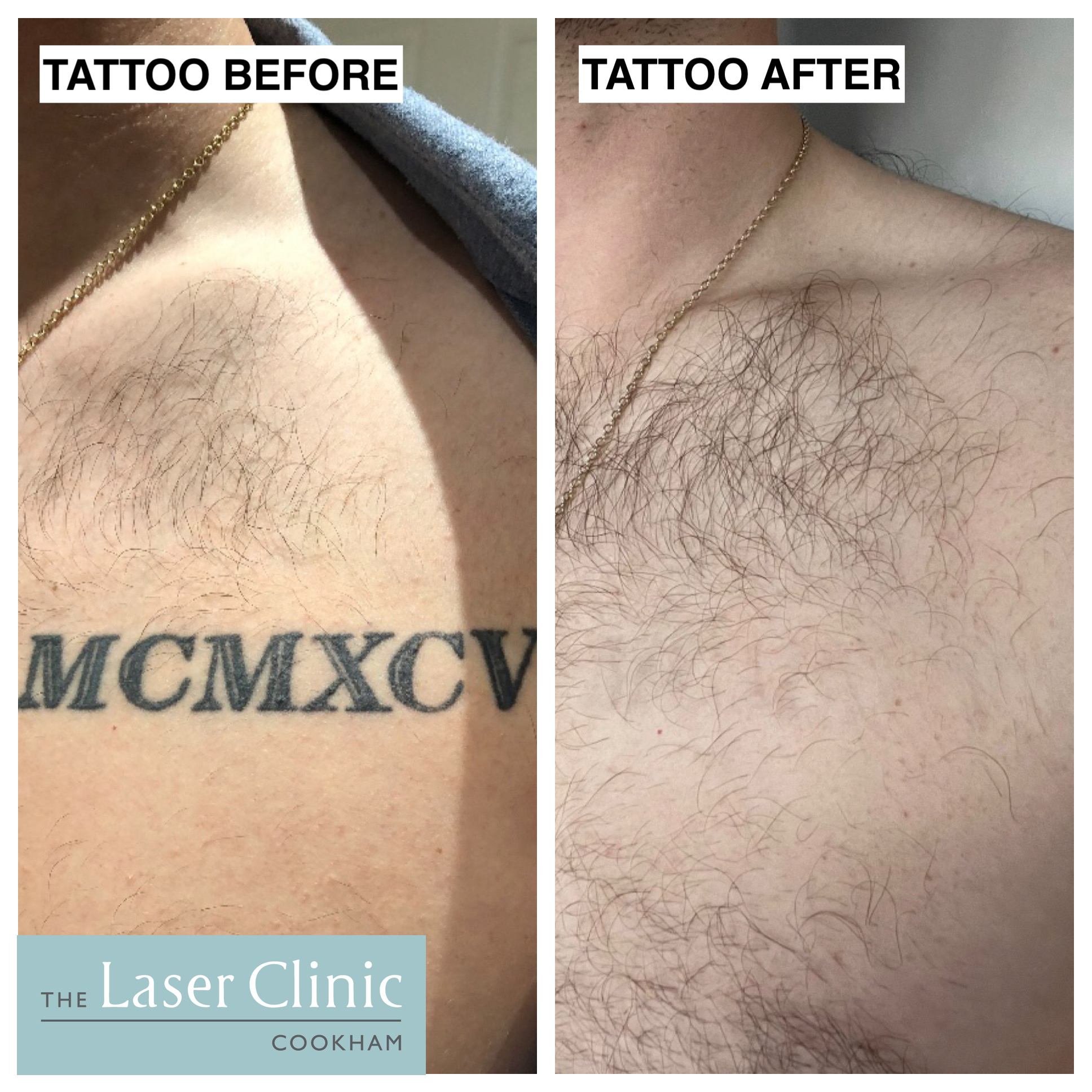 Tattoo Removal Images Before and After - ERAZALASER Clinics