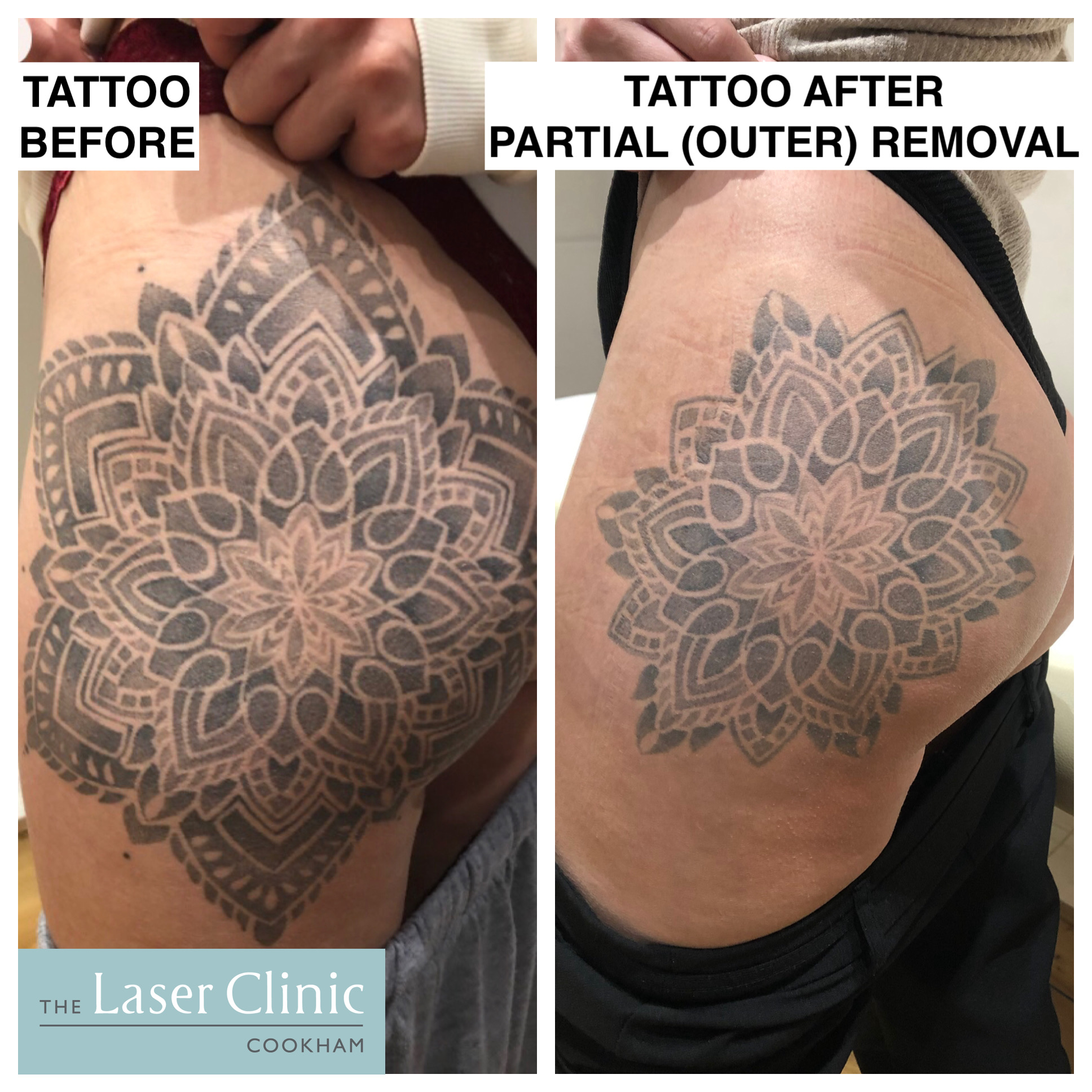 Ink Illusions - LASER TATTOO REMOVAL Before Straight afternoon patch test 2  hours after For a patch test this is a great result after 2 hours - the ink  is almost gone!